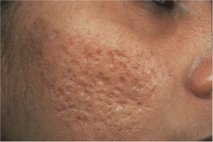 get-rid-of-acne-scars-300x2001